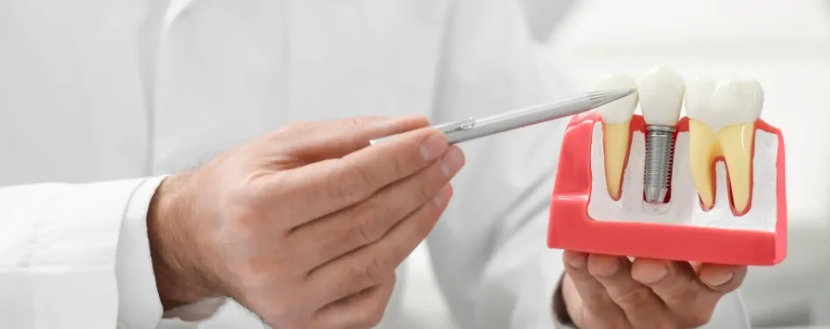 Implantes Dentários